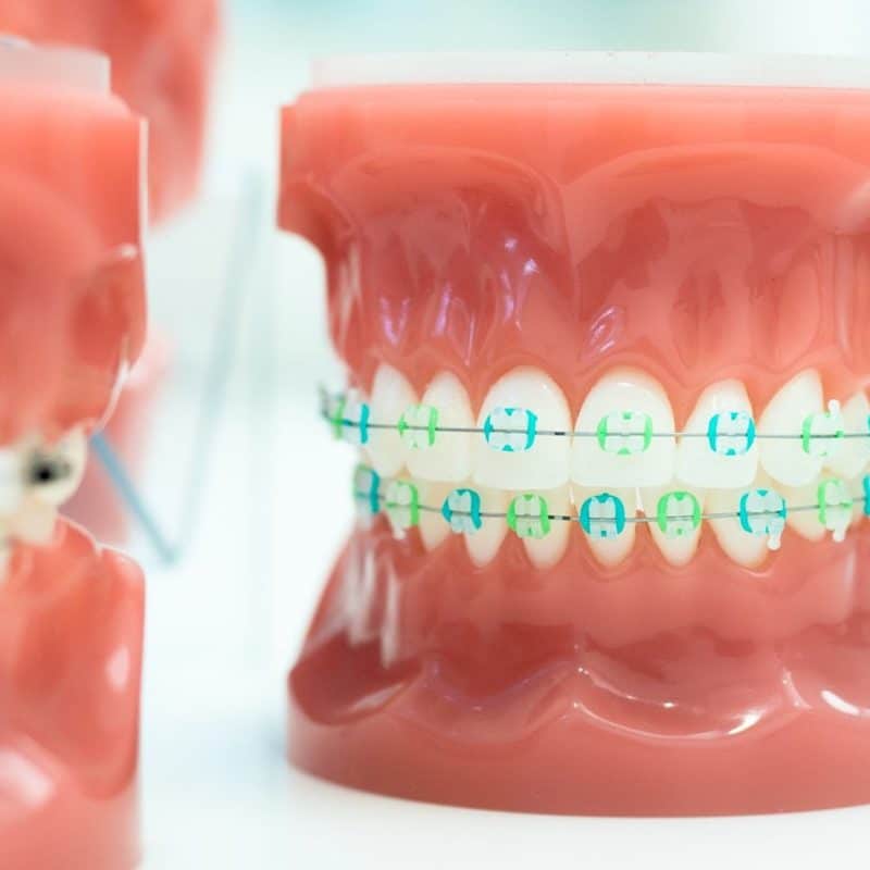 3M Clarity Clear Braces Larson Orthodontics In Alexandria VA 3m-clarity-clear-braces-larson-orthodontics-in-alexandria-va